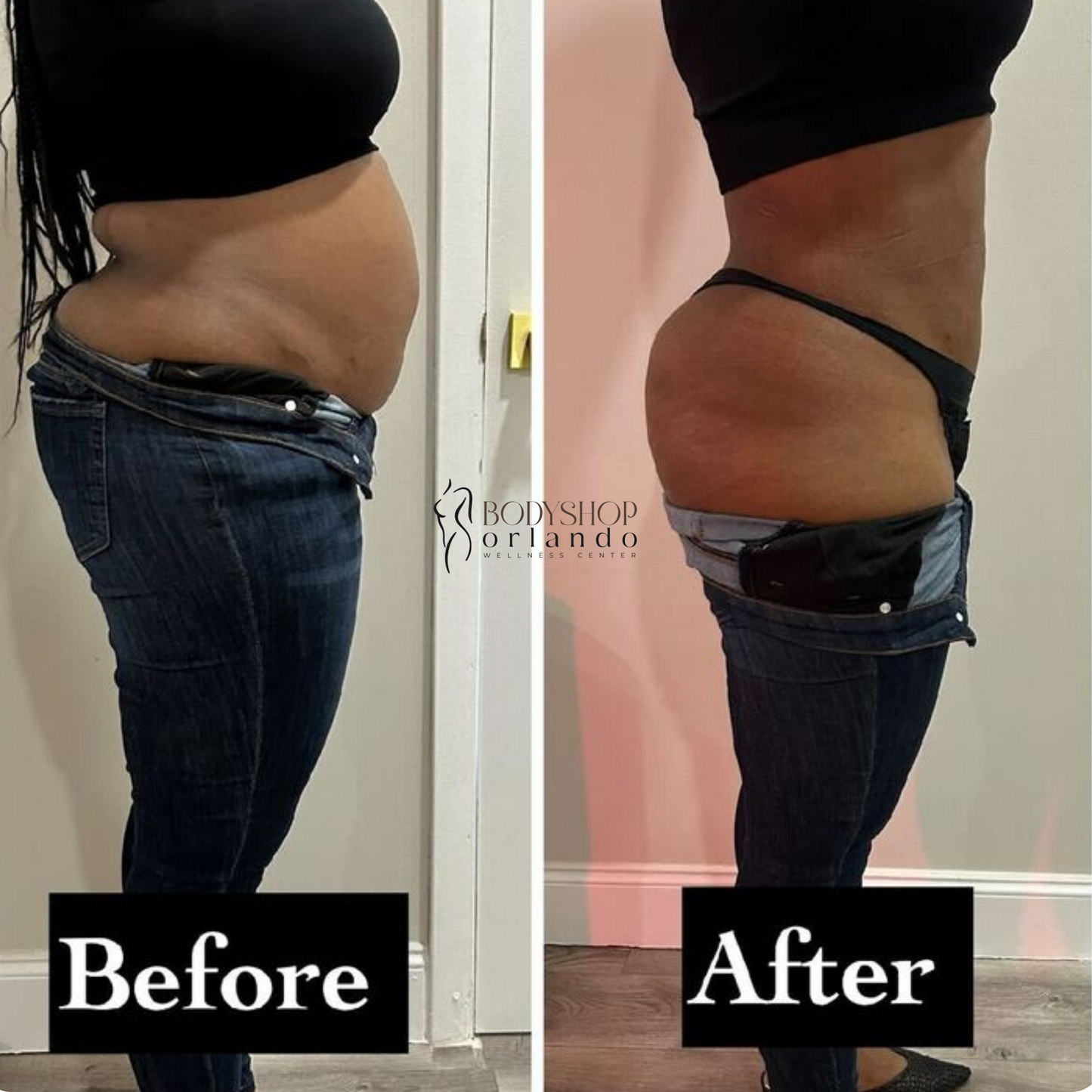 Traditional Lipo Shots
