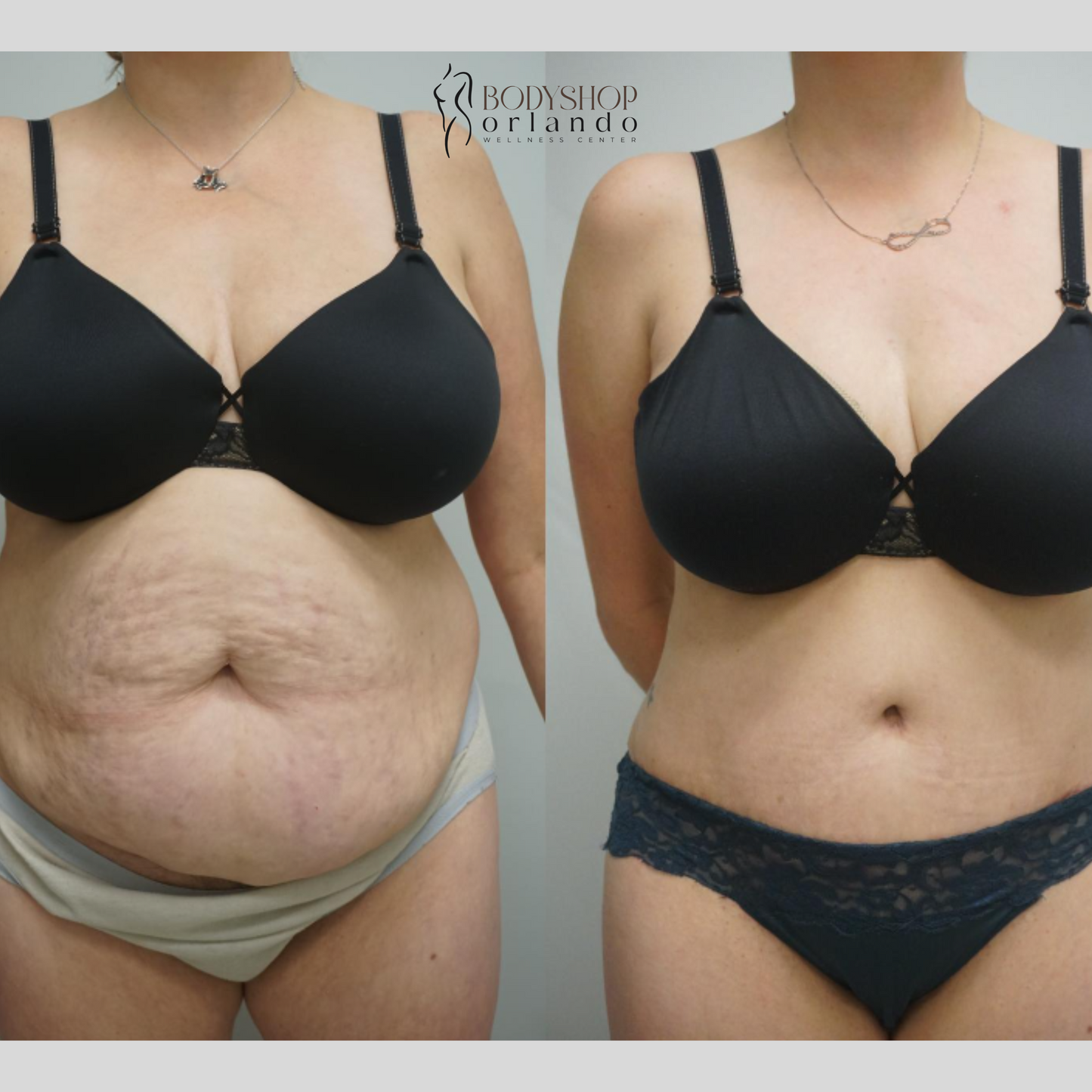 Post Op Drain Removal