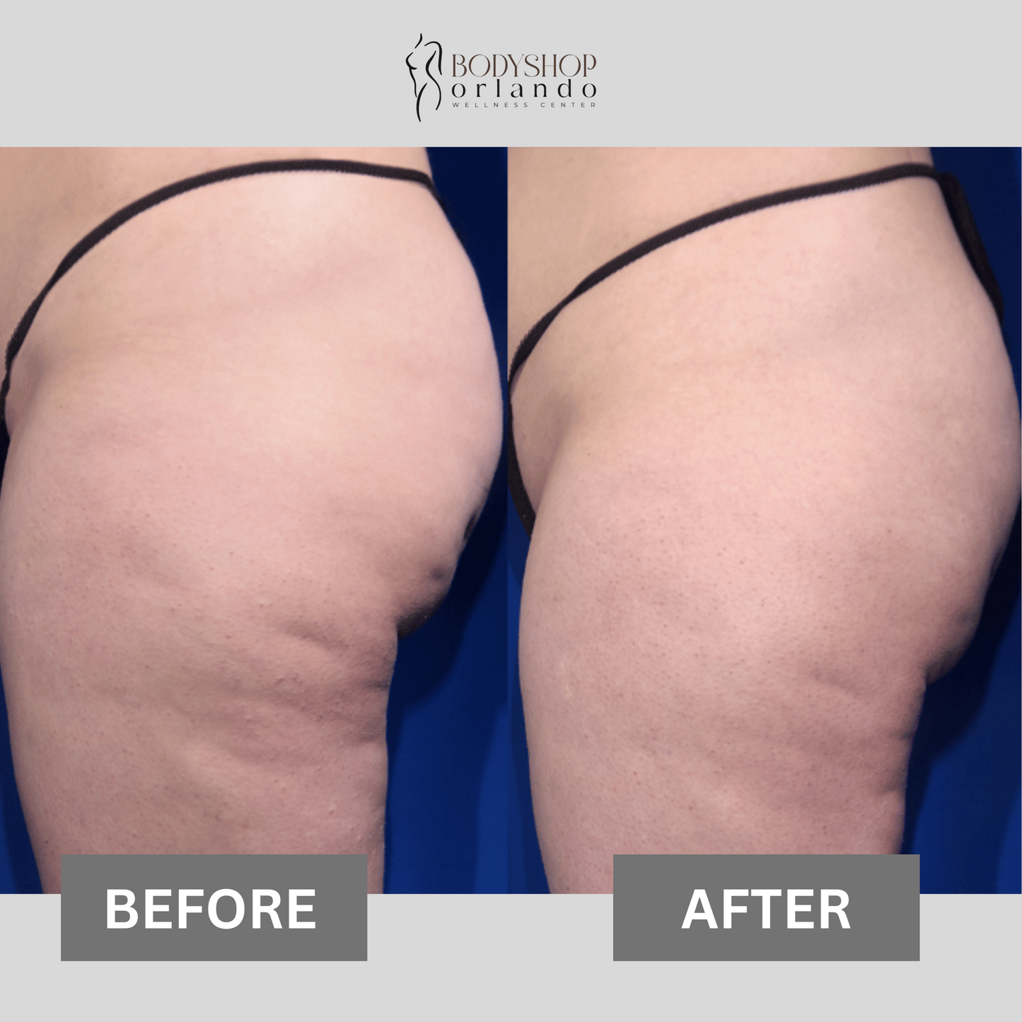 Cellulite Treatment
