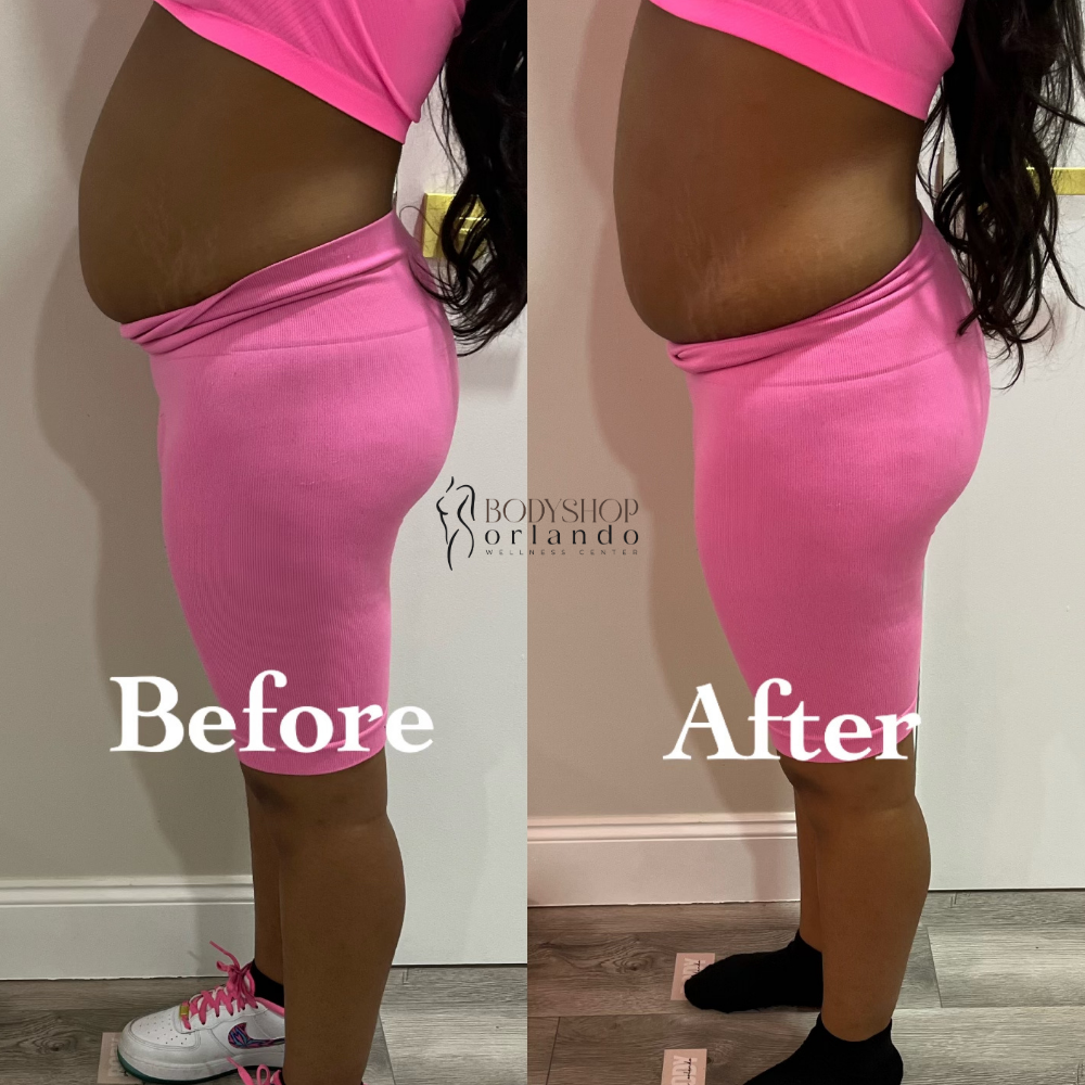 Traditional Lipo Shots