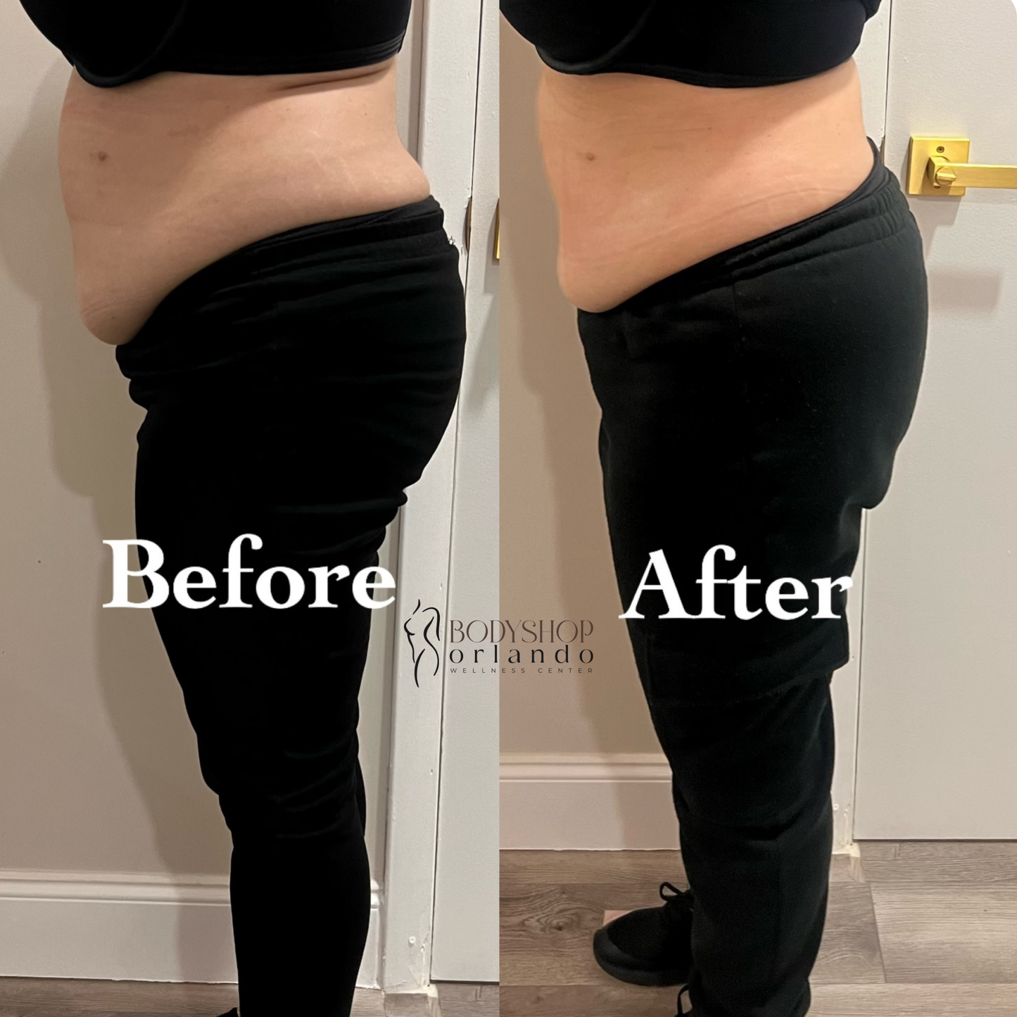 Traditional Lipo Shots