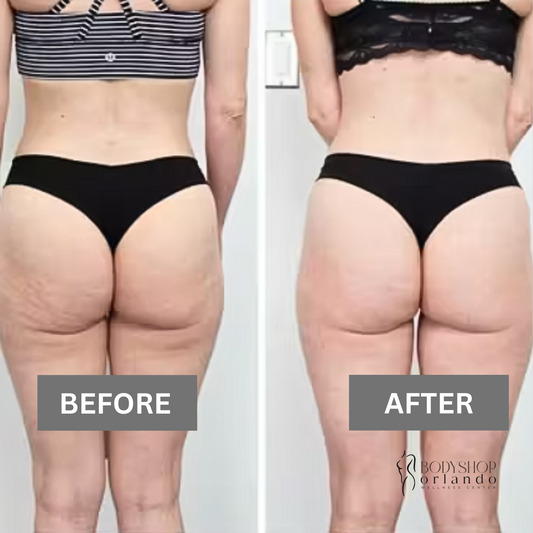 Cellulite Treatment